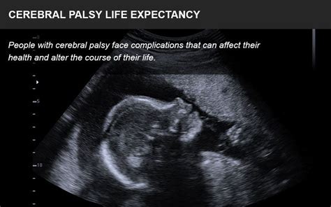 Cerebral Palsy Life Expectancy - Medical Malpractice - Impact Law