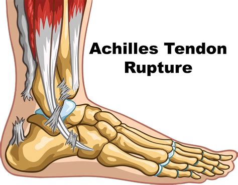 Achilles Tendon Rupture & Calf Injury - Chiropractic Scientist