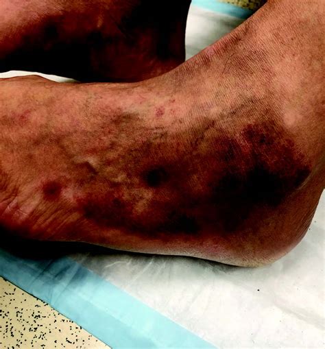 List 94+ Pictures Leg Discoloration Due To Poor Circulation Pictures Superb