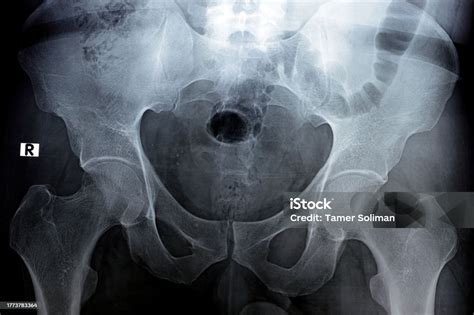 Hip Joints Digital Radiographic Examination Reveals Normal Appearance ...