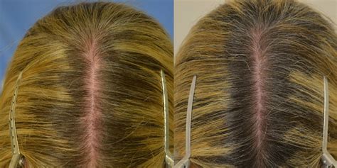 Platelet Rich Plasma (PRP) Before & After Photos - Hair Restoration of the South - New Orleans, LA