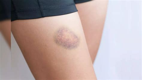 Blood clot or bruise? Know the symptoms to tell them apart | Health News, Times Now