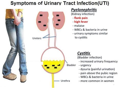 A Urinary Tract Infection Overview - Doctor Tipster