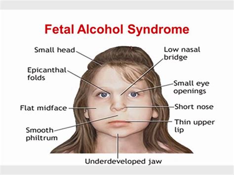 Alcohol effects a fetus | Capricorn Voice