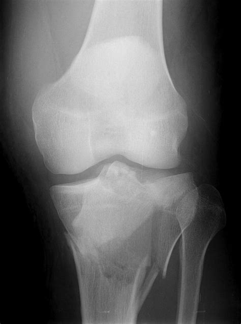 Management and incidence of tibial tubercle fractures in bicondylar fractures of the tibial ...