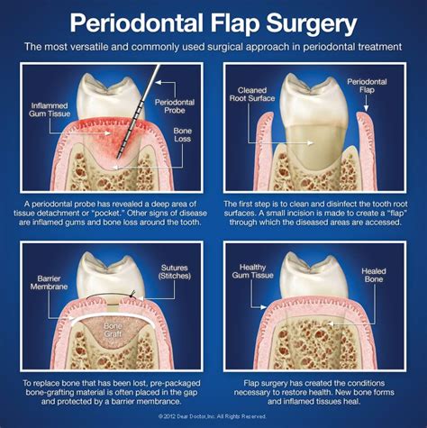 Periodontal Flap Surgery - Dentist Oneida, NY - Dental Education Library Gum Surgery, Dental ...