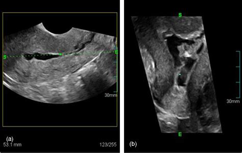 Role of 3D sonohysterography in the investigation of uterine synechiae/asherman's syndrome ...