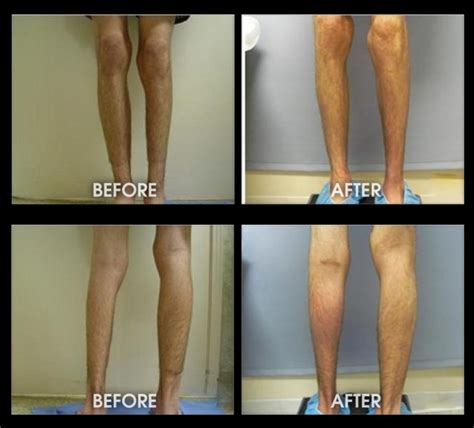 Calf Implants - Before and After Photos, Leg Muscle Augmentation