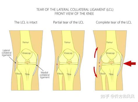 四种损伤导致膝关节稳定性下降，两个方法帮助中老年人做好预防 - 知乎