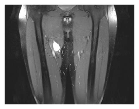 (a) T2-weighted transversal MRI image shows a hyperintense area in the... | Download Scientific ...