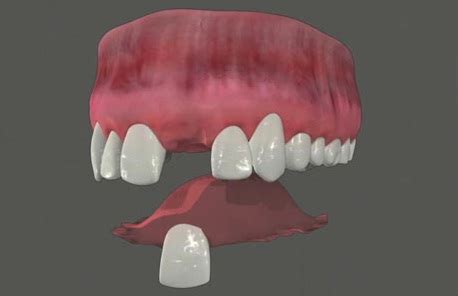 Crystal Lake Dental's Hot topics: Temproary partial denture Crystal ...