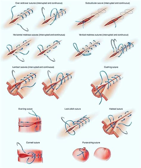 Medical Mnemonics’s Instagram photo: “Different type of surgical sutures” Surgical Suture ...