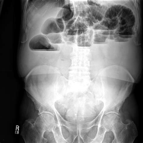 Small Bowel Obstruction 3788 Sbo Upright | Surgery Photos