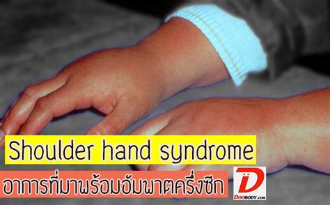 เบื่อหมอ: shoulder hand syndrome กลุ่มอาการปวดแขนแปลกๆ ที่มาพร้อมกับอัมพาต