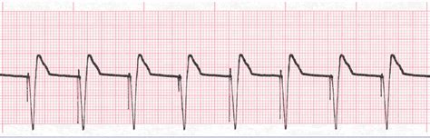 Pacemaker Rhythms: ECG class, criteria, tracings ...