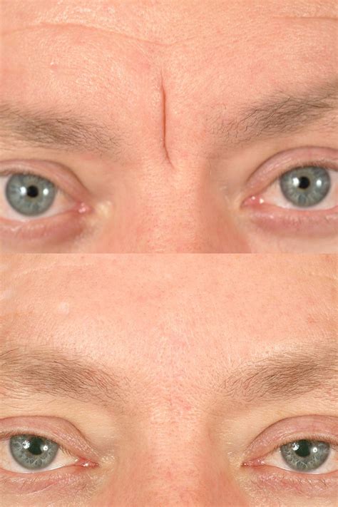 Scar Revision Before & After Photos | Dr. Benjamin Bassichis