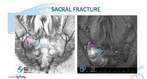 How to find a Sacral Fracture on a Lumbar MRI - Radedasia