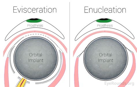 Enucleation and Evisceration: What to Expect