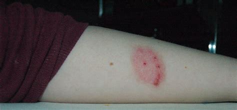 What are the most commonest spider bites symptoms? [with pictures]