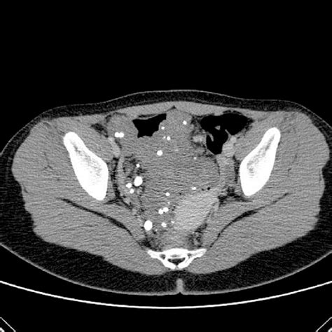 Abdominal CT scan showing increased bowel wall thickness with... | Download Scientific Diagram