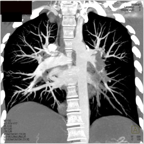 Saddle Pulmonary Embolism - Chest Case Studies - CTisus CT Scanning