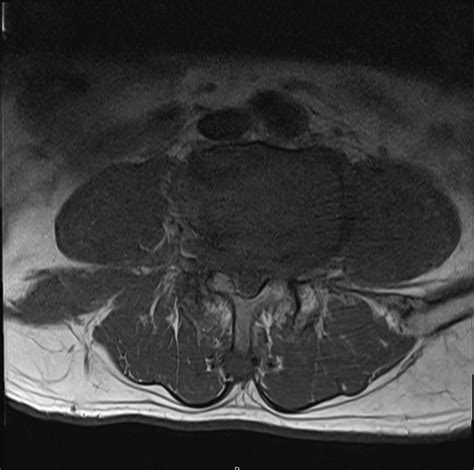 MRI Cauda equina syndrome | Radiology article on Cauda equina syndrome (CES)