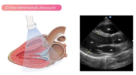 Echocardiogram Heart Ultrasound Vs