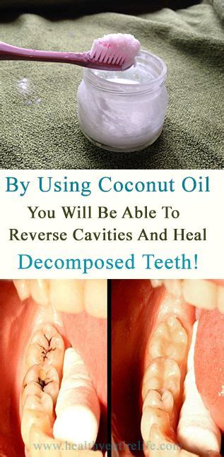 Pin by Starr-Ella's Bistro on teeth help | Natural remedies for ...