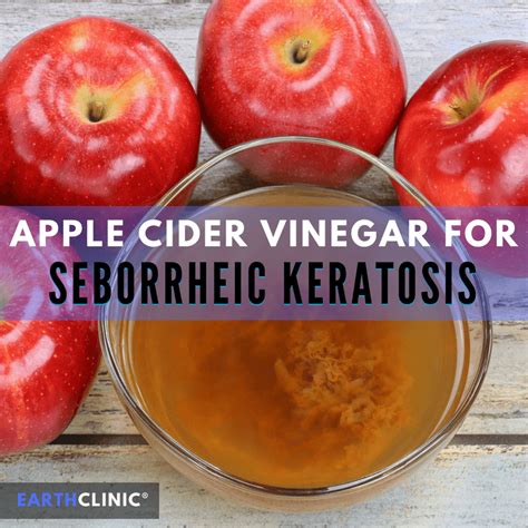 Seborrheic Keratosis Treatment Apple