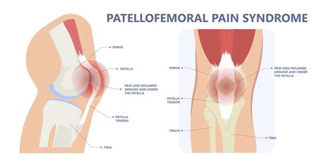 Patellofemoral Pain Syndrome (PFPS) | SportsIn Orthopaedic Clinic | Dr ...