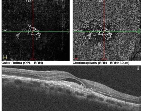 Role of OCT Angiography OCTA in the Diagnosis of Macular Diseases ...