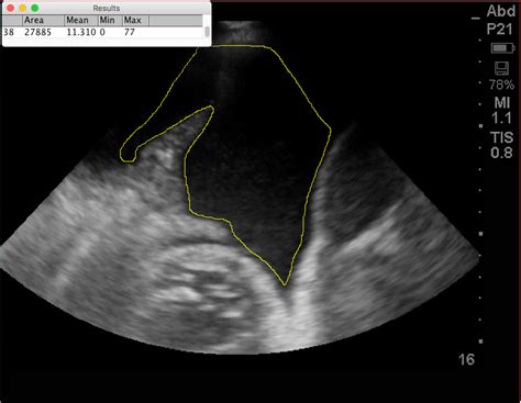 Echogenicity - Pulmonary Diseases and Critical Care