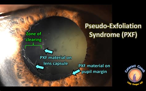 Cataract Surgery in Pseudo-Exfoliation Syndrome – Cataract Coach™