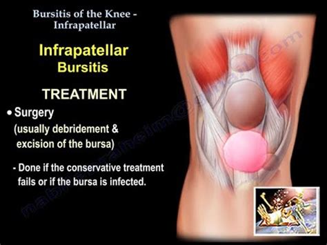 Bursitis Of The Knee Infrapatellar - Everything You Need To Know - Dr ...