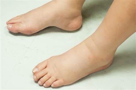 Why Do You Have Swollen Feet and Ankles? | Wellness | US News