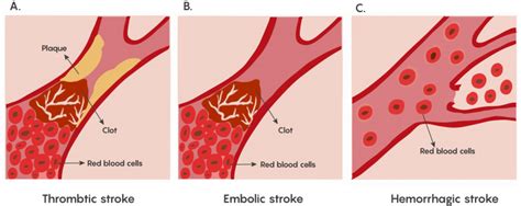 2.2 Stroke and Loss of Blood Flow as an Acute Injury to the Brain – Neuroscience: Canadian 1st ...