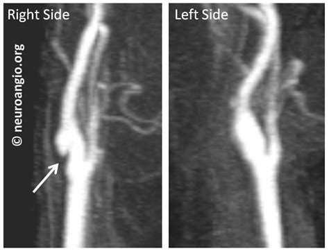 Carotid Artery Web | neuroangio.org