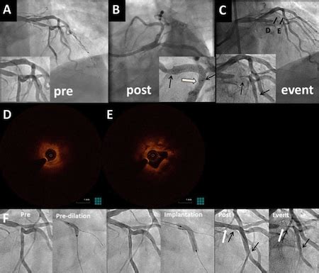 Stent Thrombosis and Failure | CardioLeFrog