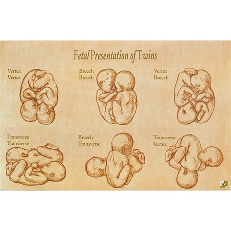 Fetal Presentation Types