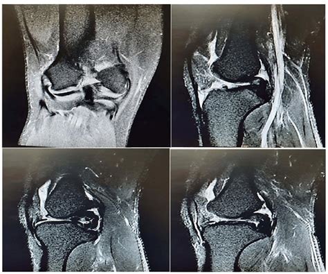 Pre-operative MRI findings of the knee joint of the patient. | Download ...