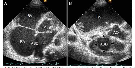 Figure 1 from En face view of atrial septal defect by two-dimensional transthoracic ...