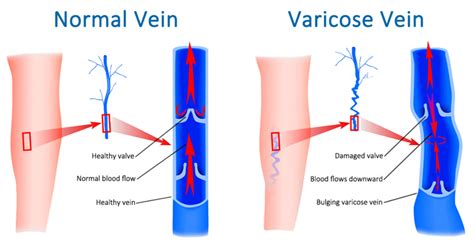 Varicose Veins: Overview, Symptoms and Diagnosis - Vascular Surgeon