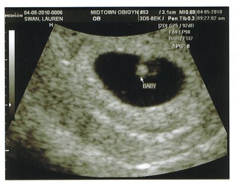 Baby Swanpenter: 6 Week Ultrasound