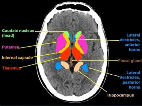 Basic ct brain and rapid CT interpretation