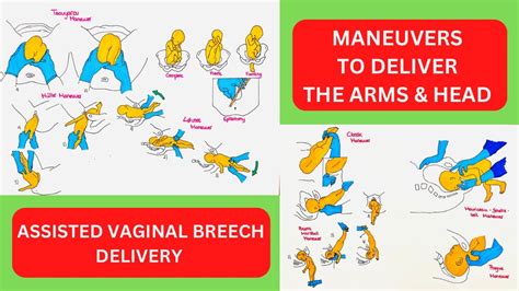 Assisted Breech Delivery - Maneuvers to Deliver Arms + Head - YouTube