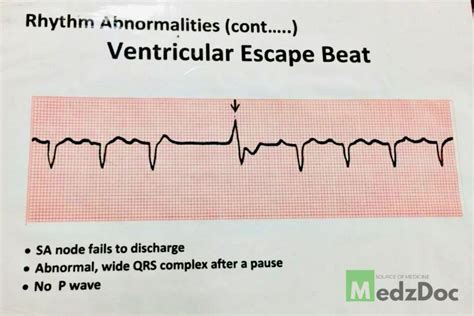 Ventricular Escape Beat https://medzdoc.blogspot.com | P wave, Rhythms, Qrs complex