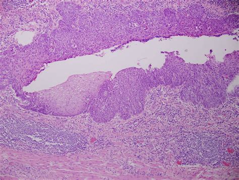 Esophageal Squamous Cell Carcinoma Histology