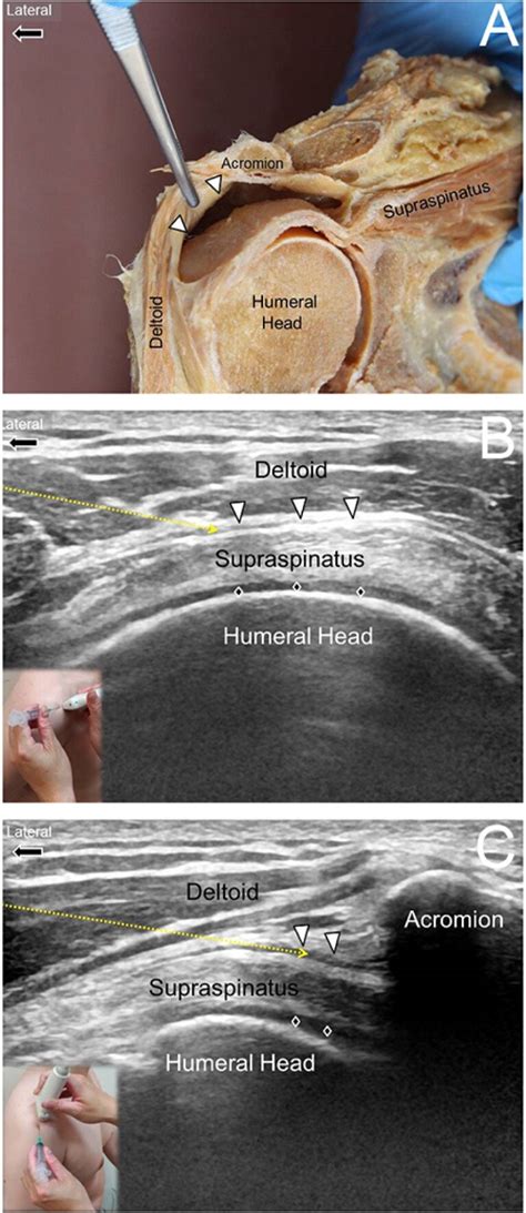 Subacromial Bursa Anatomy