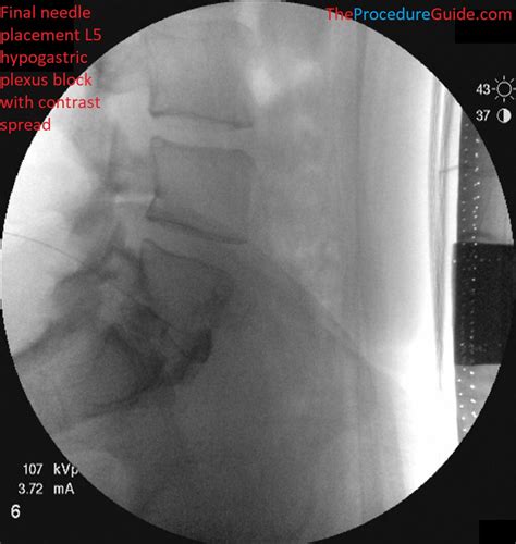 Hypogastric Plexus Block - Technique and Overview - The Procedure Guide