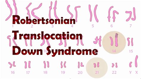 Translocation Down Syndrome Karyotype